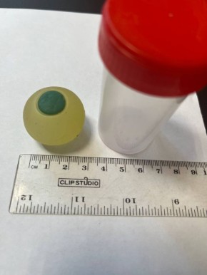 Перепутал с мармеладкой: силиконовый глаз достали из кишечника девятилетнего мальчика