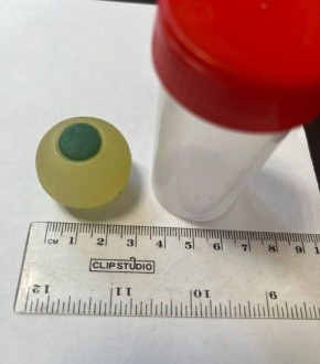 Навстречу Хэллоуину! В Челябинске хирурги достали из кишечника школьника силиконовый глаз