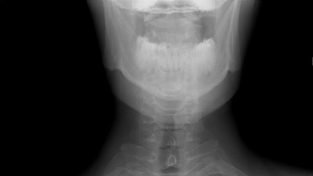 В Челябинске школьница сломала три позвонка на уроке физкультуры