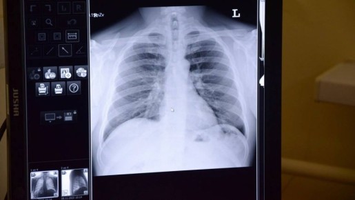 Микоплазменная пневмония: как распознать и защититься