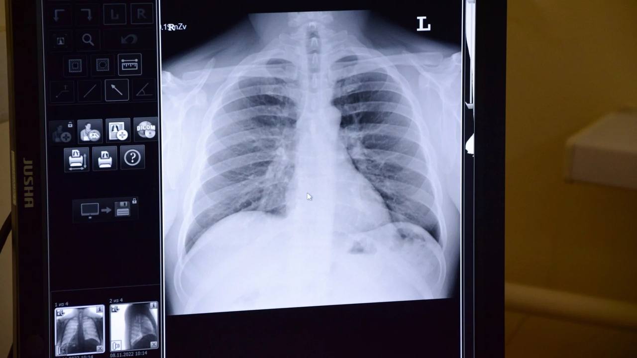 Микоплазменная пневмония: как распознать и защититься