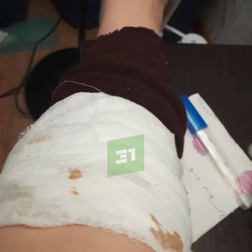 СК возбудил уголовное дело после нападения бездомных собак на жительницу Магнитогорска