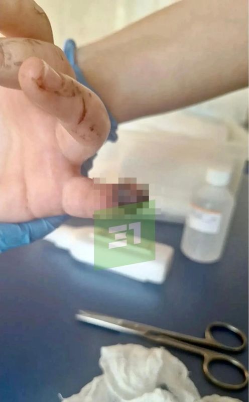 Девочка потеряла часть пальца, возбуждено уголовное дело