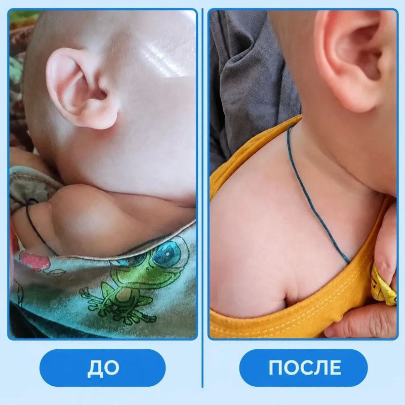 Малоинвазивные технологии в ЧОДКБ: новый взгляд на лечение сосудистых мальформаций Малоинвазивные технологии в ЧОДКБ: новый взгляд на лечение сосудистых мальформаций